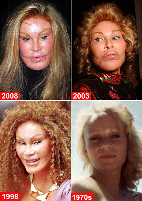 Donatella Versace Before Plastic Surgery